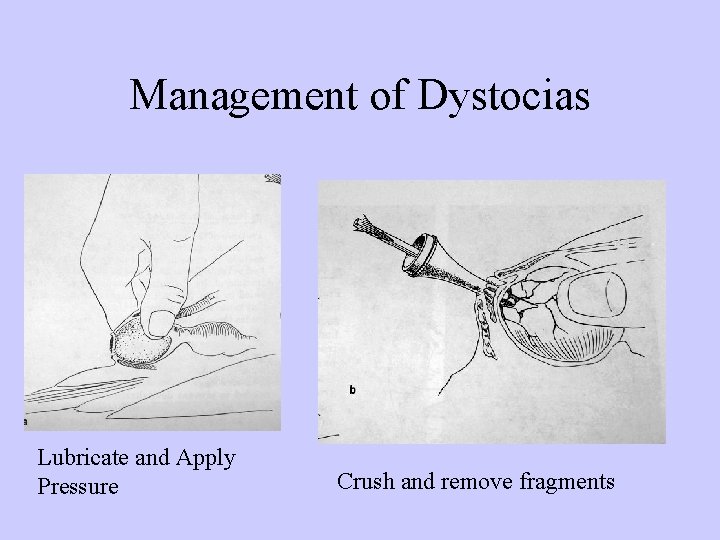 Management of Dystocias Lubricate and Apply Pressure Crush and remove fragments 