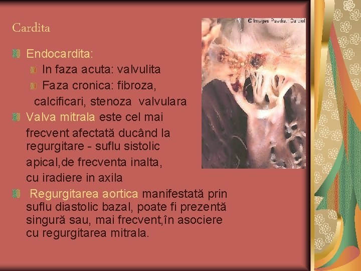 Cardita Endocardita: In faza acuta: valvulita Faza cronica: fibroza, calcificari, stenoza valvulara Valva mitrala