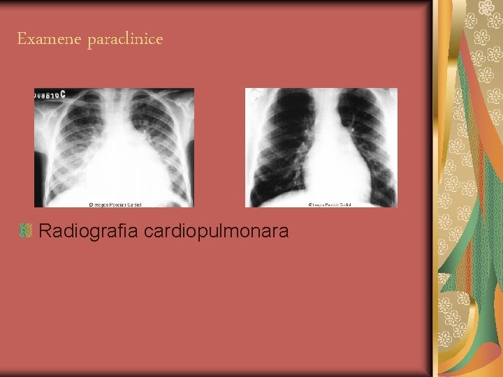 Examene paraclinice Radiografia cardiopulmonara 