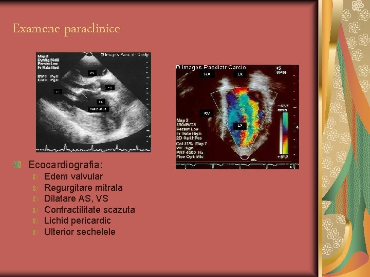 Examene paraclinice Ecocardiografia: Edem valvular Regurgitare mitrala Dilatare AS, VS Contractilitate scazuta Lichid pericardic