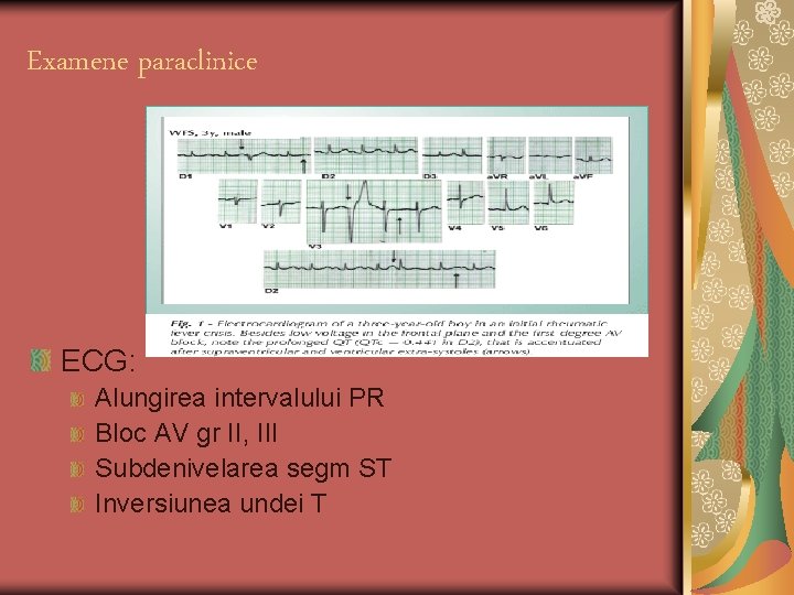 Examene paraclinice ECG: Alungirea intervalului PR Bloc AV gr II, III Subdenivelarea segm ST