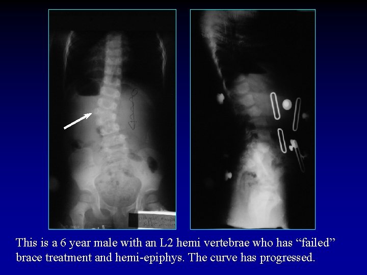 This is a 6 year male with an L 2 hemi vertebrae who has
