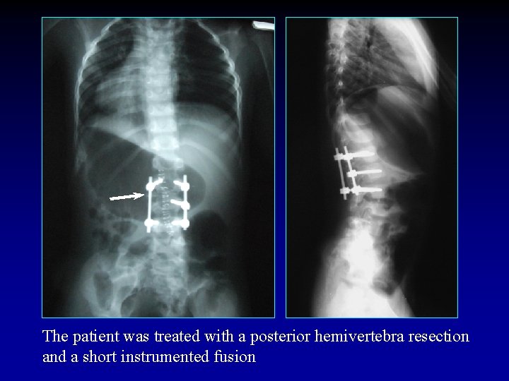 The patient was treated with a posterior hemivertebra resection and a short instrumented fusion