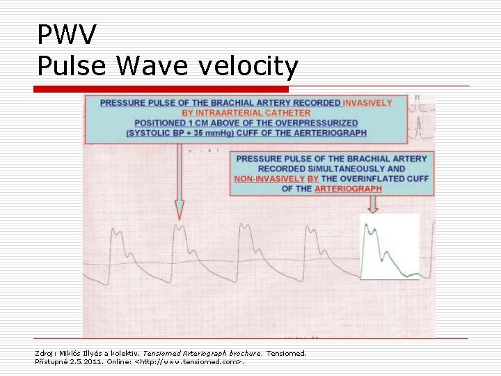 PWV Pulse Wave velocity Zdroj: Miklós Illyés a kolektiv. Tensiomed Arteriograph brochure. Tensiomed. Přístupné