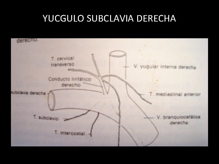 YUCGULO SUBCLAVIA DERECHA 