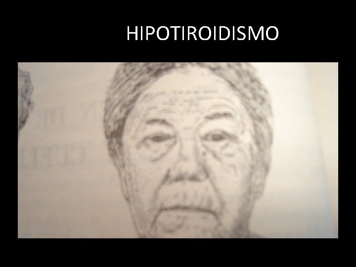 HIPOTIROIDISMO 