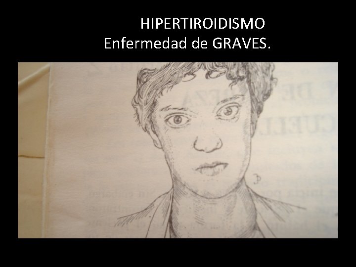 HIPERTIROIDISMO Enfermedad de GRAVES. 