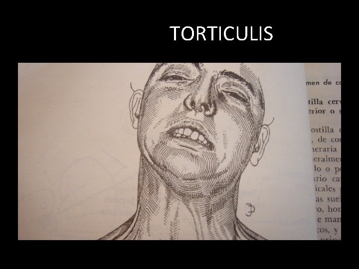TORTICULIS 