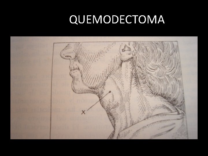 QUEMODECTOMA 