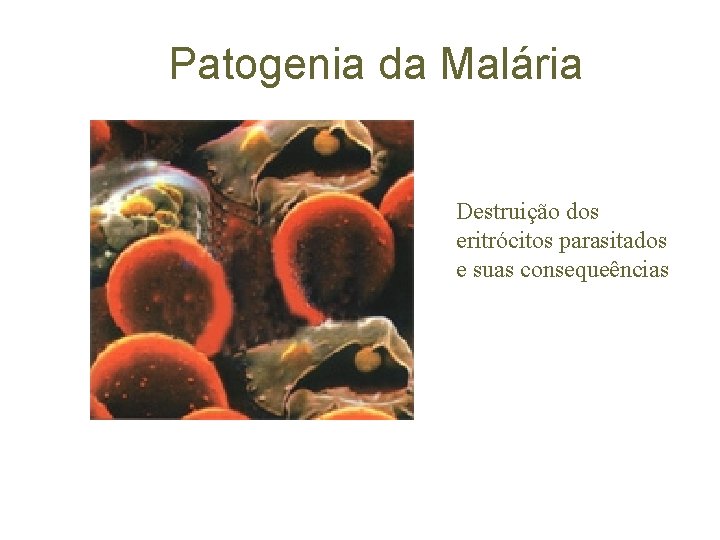 Patogenia da Malária Destruição dos eritrócitos parasitados e suas consequeências 