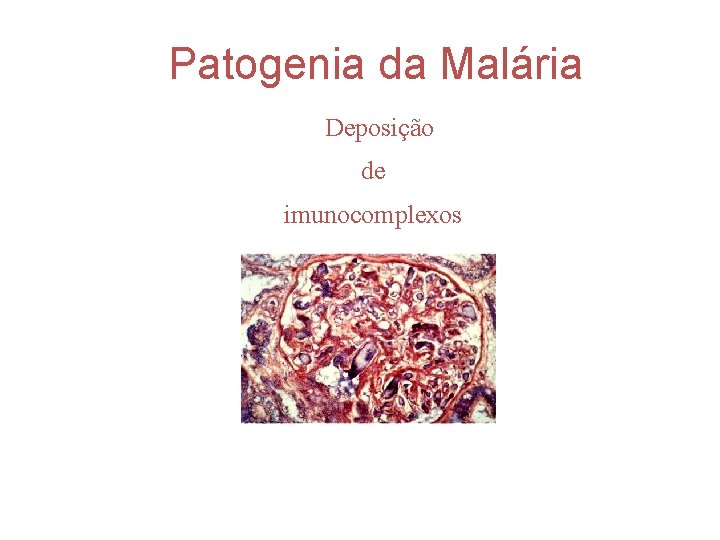 Patogenia da Malária Deposição de imunocomplexos 