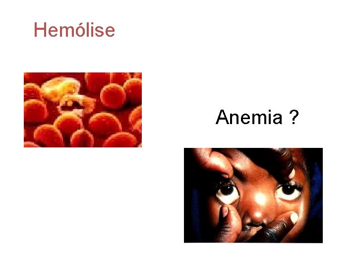 Hemólise Anemia ? 