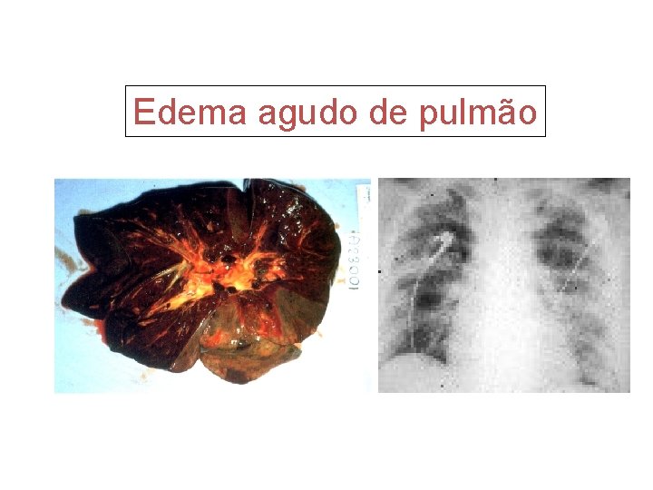 Edema agudo de pulmão 