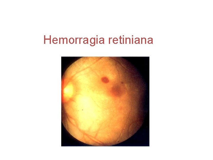Hemorragia retiniana 