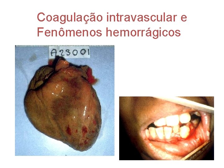 Coagulação intravascular e Fenômenos hemorrágicos 