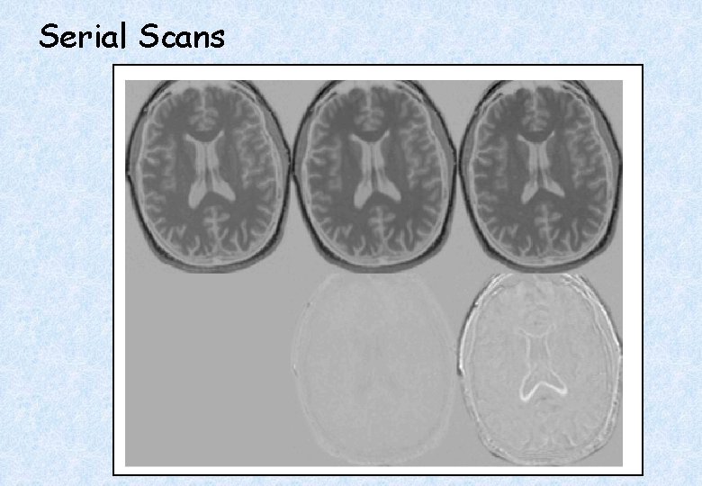Serial Scans Early Late Difference Data from the Dementia Research Group, Queen Square. 