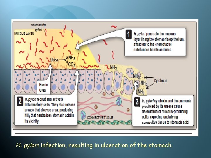 H. pylori infection, resulting in ulceration of the stomach. 