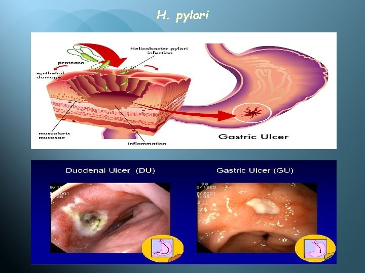 H. pylori 