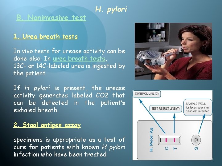 B. Noninvasive test H. pylori 1. Urea breath tests In vivo tests for urease