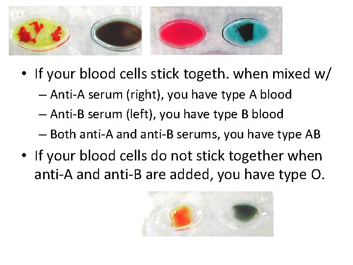  • If your blood cells stick togeth. when mixed w/ – Anti-A serum