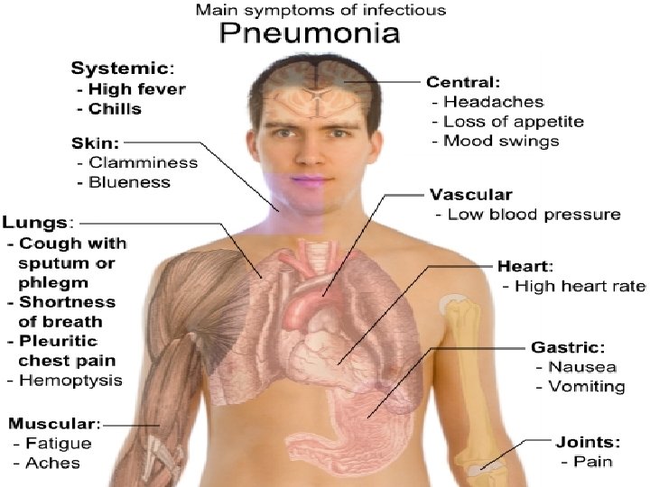 Pneumonia vaccine The pneumonia vaccine protects against pneumococcal infections. A pneumonia infection can affect