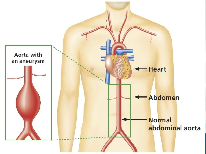 Abdominal aortic aneurysm screening The aorta is the main blood vessel that supplies blood