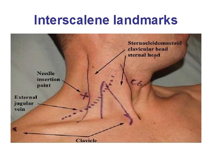 Interscalene landmarks 