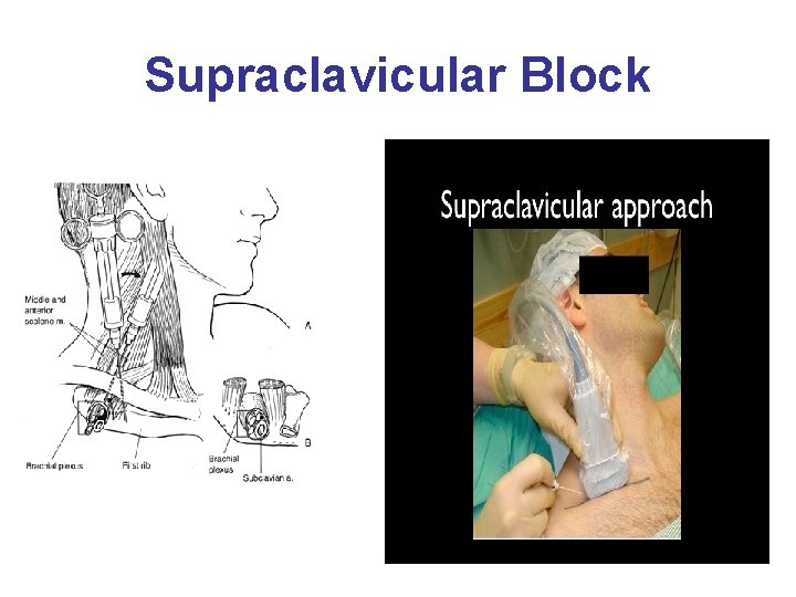 Supraclavicular Block 