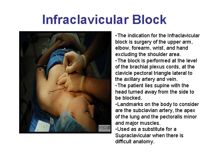 Infraclavicular Block • The indication for the Infraclavicular block is surgery of the upper