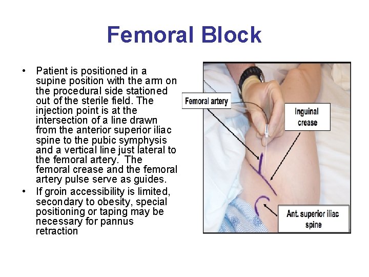 Femoral Block • Patient is positioned in a supine position with the arm on
