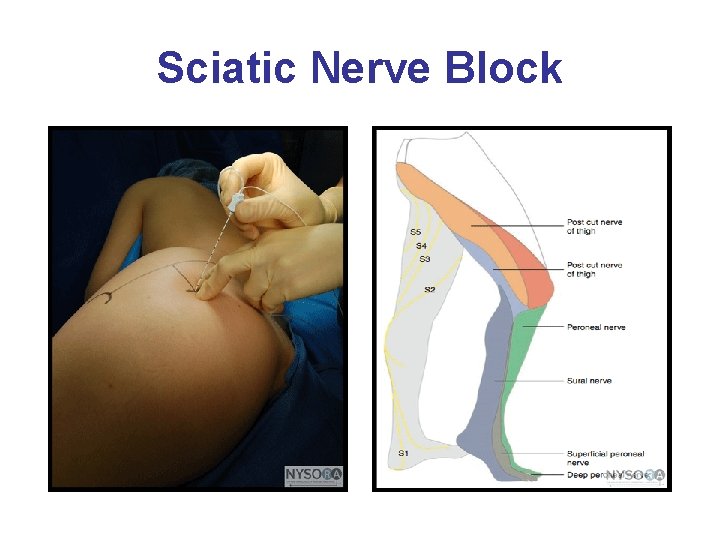 Sciatic Nerve Block 