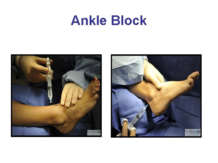 Ankle Block 