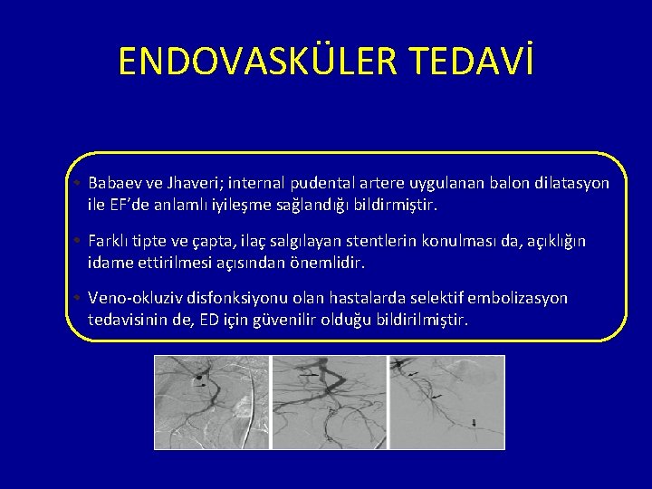 ENDOVASKÜLER TEDAVİ Babaev ve Jhaveri; internal pudental artere uygulanan balon dilatasyon ile EF’de anlamlı