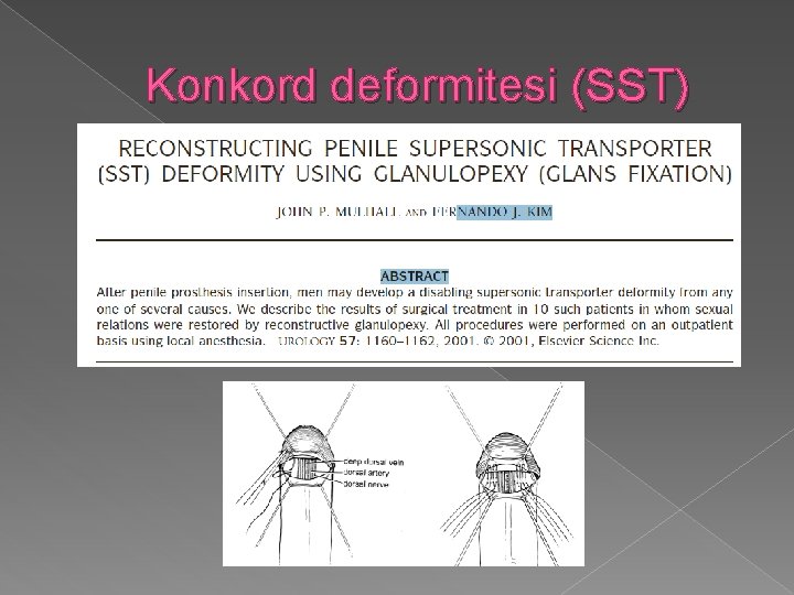 Konkord deformitesi (SST) 