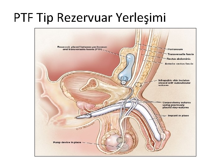 PTF Tip Rezervuar Yerleşimi 