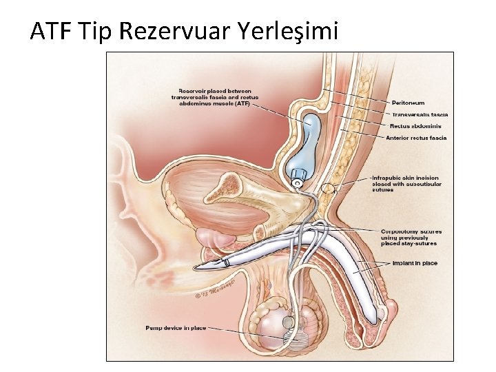 ATF Tip Rezervuar Yerleşimi 