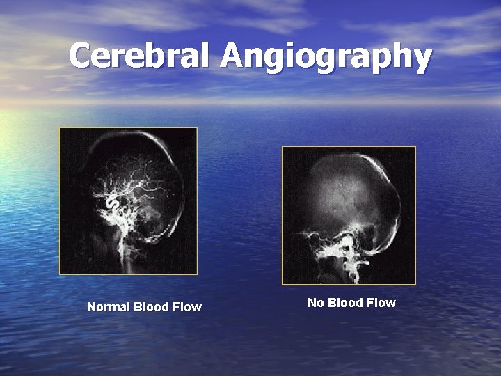 Cerebral Angiography Normal Blood Flow No Blood Flow 