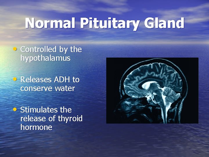 Normal Pituitary Gland • Controlled by the hypothalamus • Releases ADH to conserve water