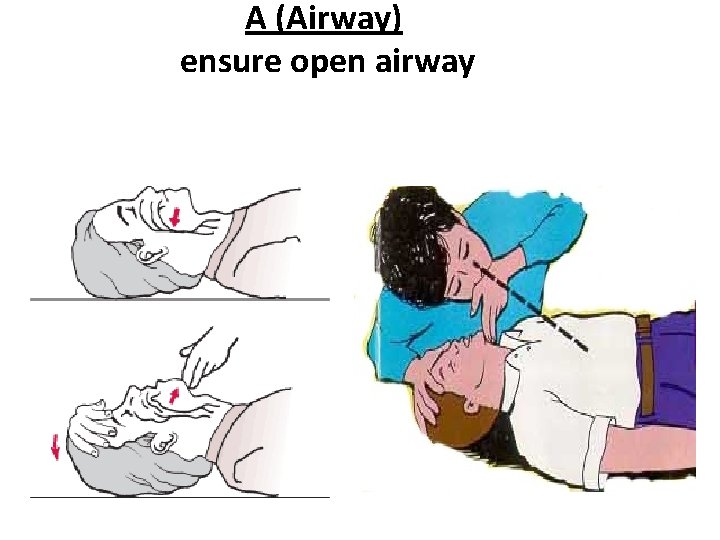 A (Airway) ensure open airway 