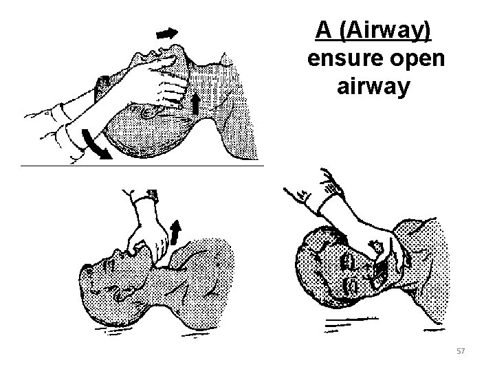 A (Airway) ensure open airway 57 