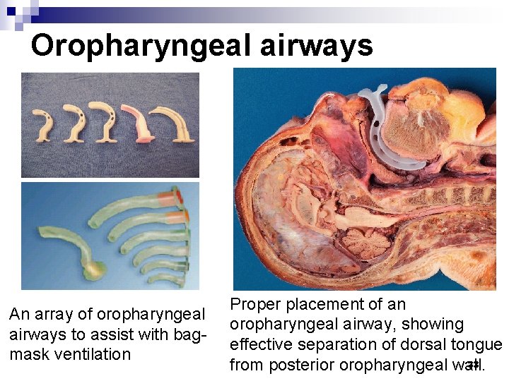 Oropharyngeal airways An array of oropharyngeal airways to assist with bagmask ventilation Proper placement