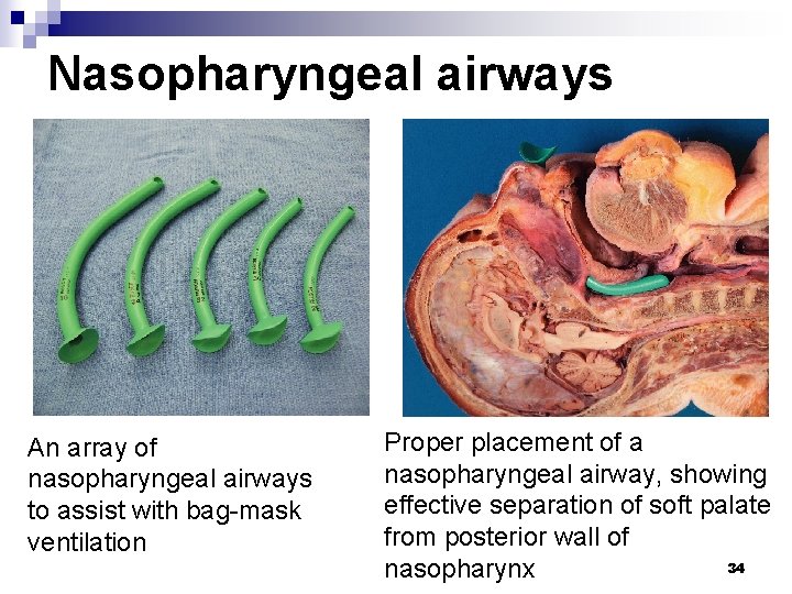 Nasopharyngeal airways An array of nasopharyngeal airways to assist with bag-mask ventilation Proper placement