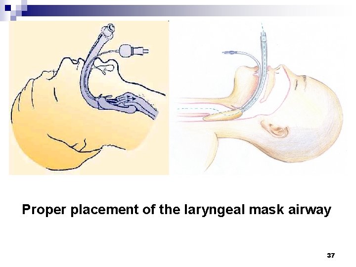 Proper placement of the laryngeal mask airway 37 