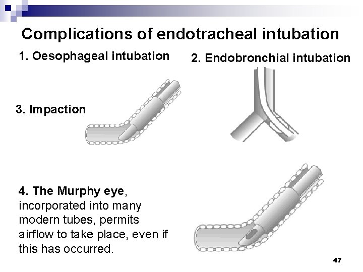 Complications of endotracheal intubation 1. Oesophageal intubation 2. Endobronchial intubation 3. Impaction 4. The