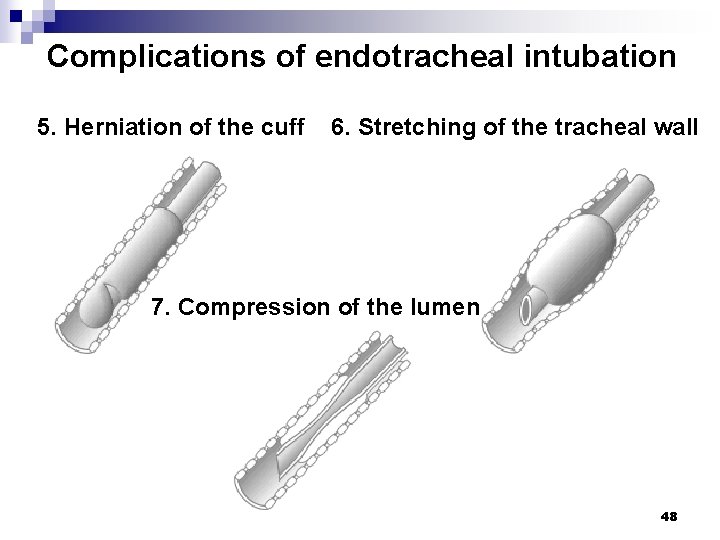 Complications of endotracheal intubation 5. Herniation of the cuff 6. Stretching of the tracheal