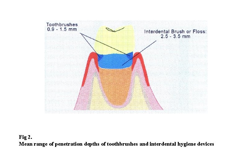 Fig 2. Mean range of penetration depths of toothbrushes and interdental hygiene devices 