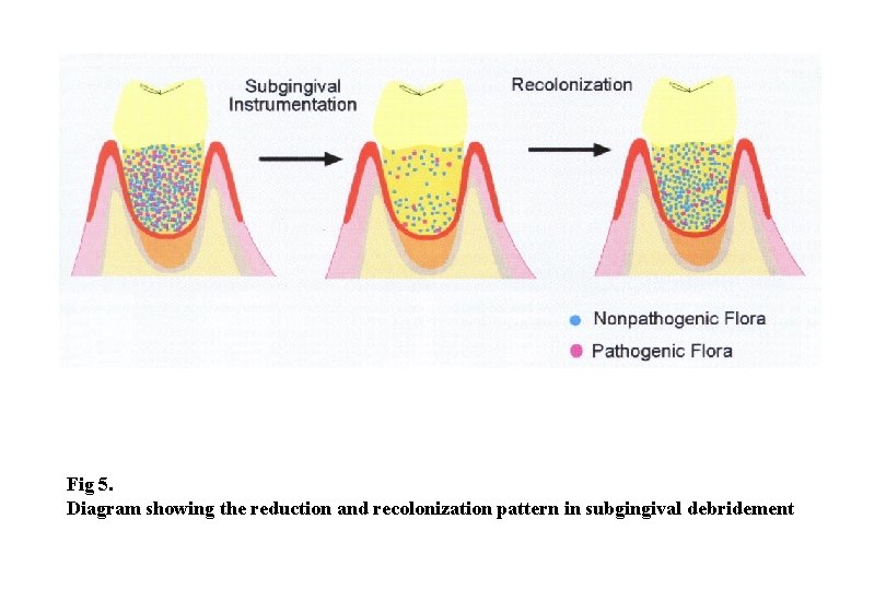 Fig 5. Diagram showing the reduction and recolonization pattern in subgingival debridement 