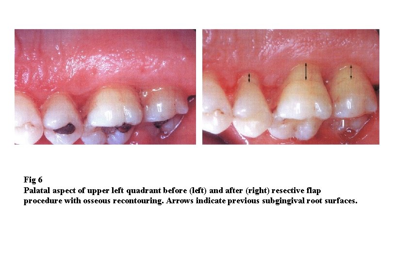 Fig 6 Palatal aspect of upper left quadrant before (left) and after (right) resective