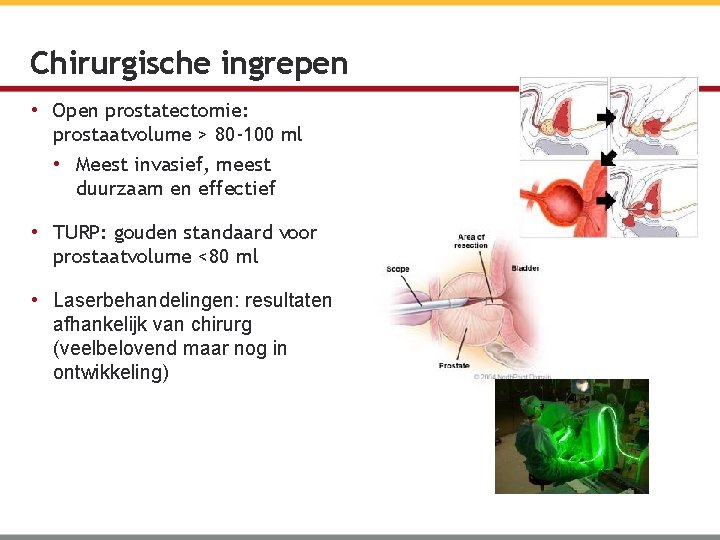 Chirurgische ingrepen • Open prostatectomie: prostaatvolume > 80 -100 ml • Meest invasief, meest