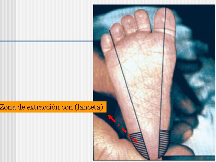 Zona de extracción con (lanceta) 